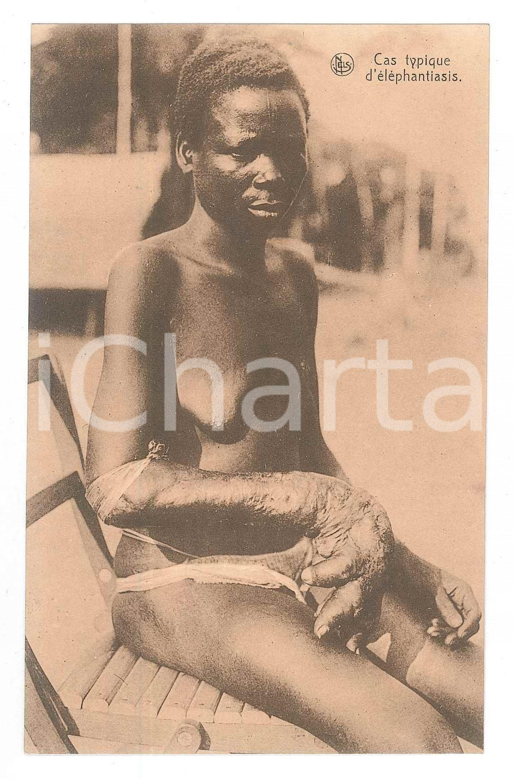 1930 ca AFRIQUE Cas typique d'éléphantiasis - Carte postale (2)  Cartolina d'epoca, non viaggiata. FAIR/discreto Lievi smussature agli angoli Formato: 14x9 originale e autentica 1