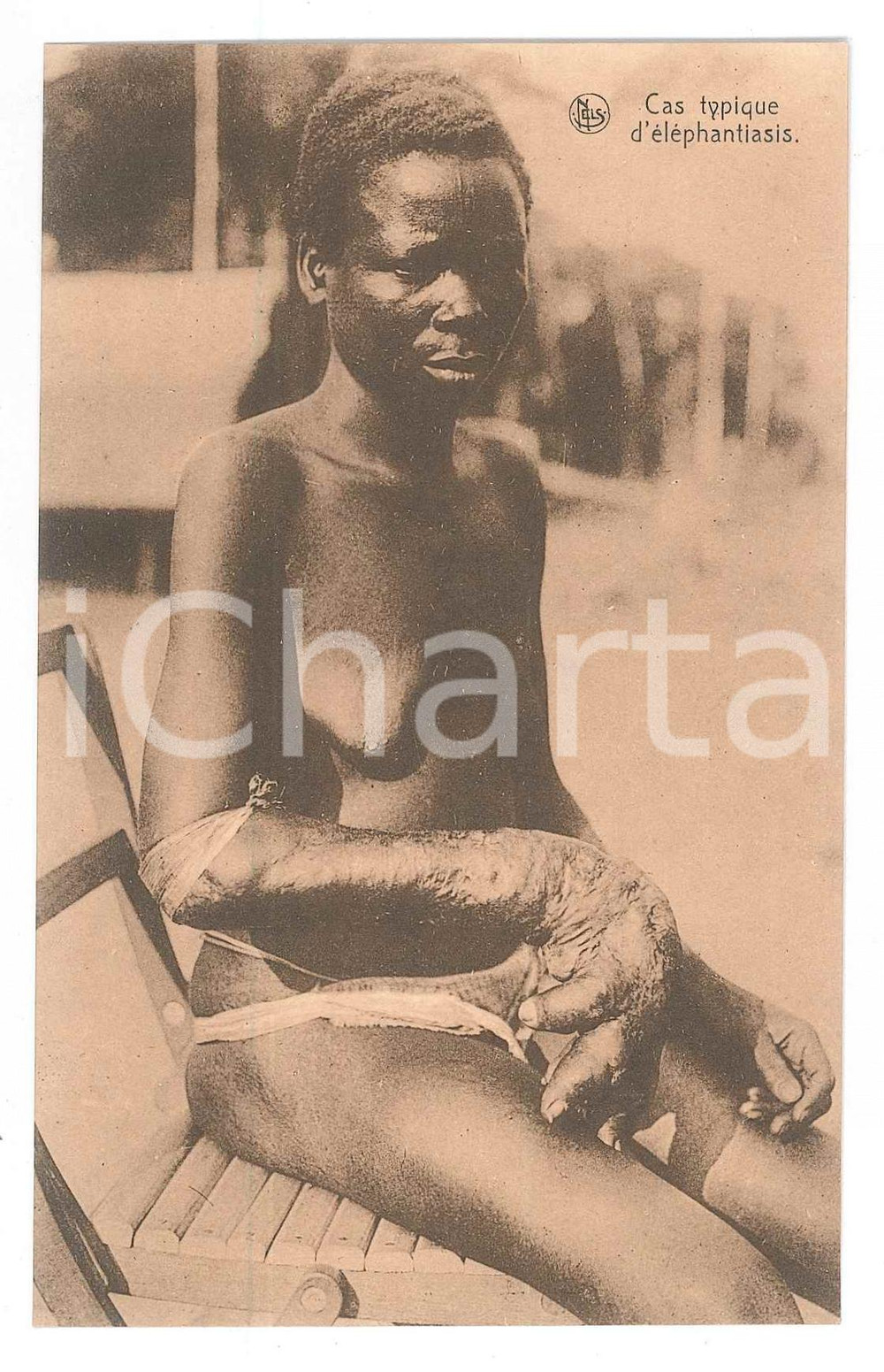 1930 ca AFRIQUE Cas typique d'éléphantiasis - Carte postale (4)  Cartolina d'epoca, non viaggiata. FAIR/discreto Lievi smussature agli angoli Formato: 14x9 originale e autentica 1