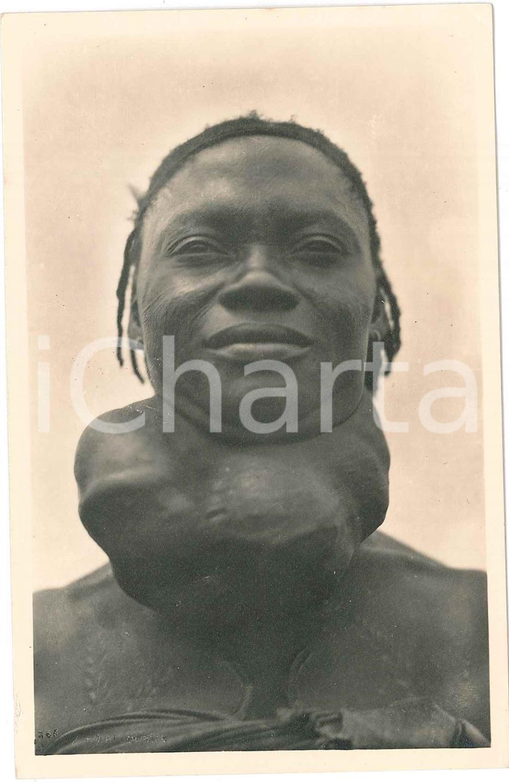 1930 ca ZAGOURSKI «L'Afrique qui disparaît» Maladies tropicales: le goitre (2)  Fotocartolina postale d'epoca, appartenente alla serie &laquo;L'Afrique qui dispara&icirc;t&raquo; del fotografo Casimir Zagourski (L&eacute;opoldville).N&deg; 164, non viaggiata.CONDIZIONI: GFORMATO: 9x14 cm     originale e autentica 1