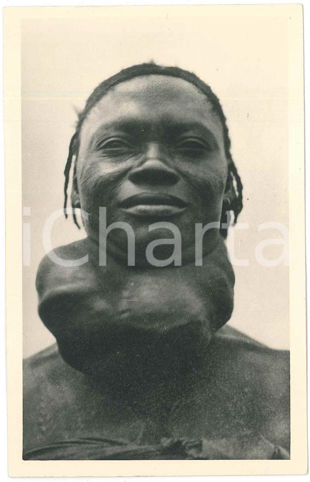 1930 ca ZAGOURSKI «L'Afrique qui disparaît» Maladies tropicales: le goitre (3)  Fotocartolina postale d'epoca, appartenente alla serie &laquo;L'Afrique qui dispara&icirc;t&raquo; del fotografo Casimir Zagourski (L&eacute;opoldville).N&deg; 164, non viaggiata.Al verso timbro: "Henri Nicaise Photographe - Namur"CONDIZIONI: GFORMATO: 9x14 cm     originale e autentica 1
