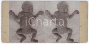 1910 ca DISEASES - ODDITIES - Abortion - RARE MEDICAL Stereoview (1) Fotografia stereoscopica d'epoca, su cartoncino rigido. FAIR/discreto fioriture Formato: 18x9 cm originale e autentica 1