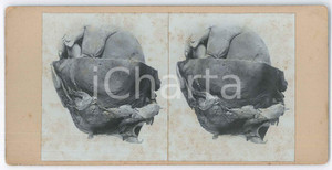 1910 ca DISEASES - Abortion - Foetuses - RARE MEDICAL Stereoview (3) Fotografia stereoscopica d'epoca, su cartoncino rigido. POOR/danneggiato fioriture Formato: 18x9 cm originale e autentica 1