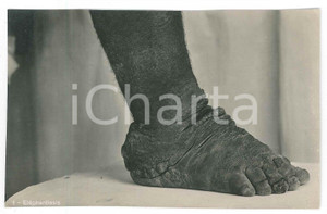 1930 ca C. ZAGOURSKI «L'Afrique qui disparaît» Maladies tropicales 163A 3  Fotocartolina postale d'epoca, appartenente alla serie &laquo;L'Afrique qui dispara&icirc;t&raquo; del fotografo Casimir Zagourski (L&eacute;opoldville),N&deg;163A, non viaggiata.CONDIZIONI: GFORMATO: 9x14 cm    originale e autentica 1