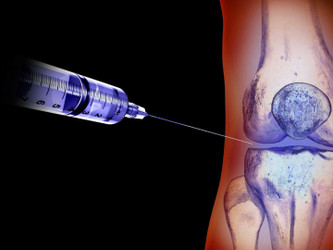 Infiltrazioni Intrarticolari