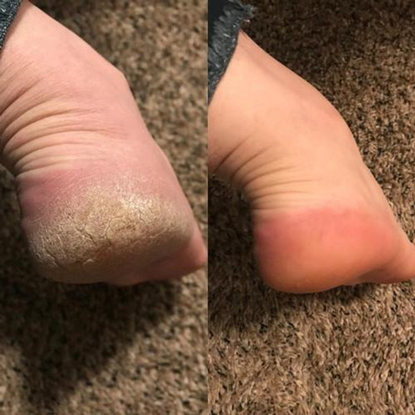 Râpe Pieds Électrique Anti-Callosités Râpe Pieds Électrique Anti-Callosités zaxx