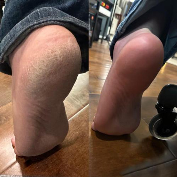Râpe Pieds Électrique Anti-Callosités Râpe Pieds Électrique Anti-Callosités zaxx