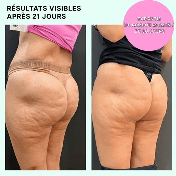Masseur Anti-Cellulite 3-en-1 Masseur Anti-Cellulite 3-en-1 zaxx