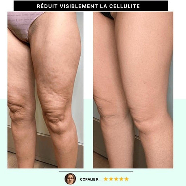 Masseur Anti-Cellulite 3-en-1 Masseur Anti-Cellulite 3-en-1 zaxx