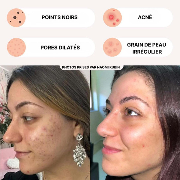 Aspirateur Point Noir - Extracteur Points Noirs Visage Aspirateur Point Noir - Extracteur Points Noirs Visage zaxx