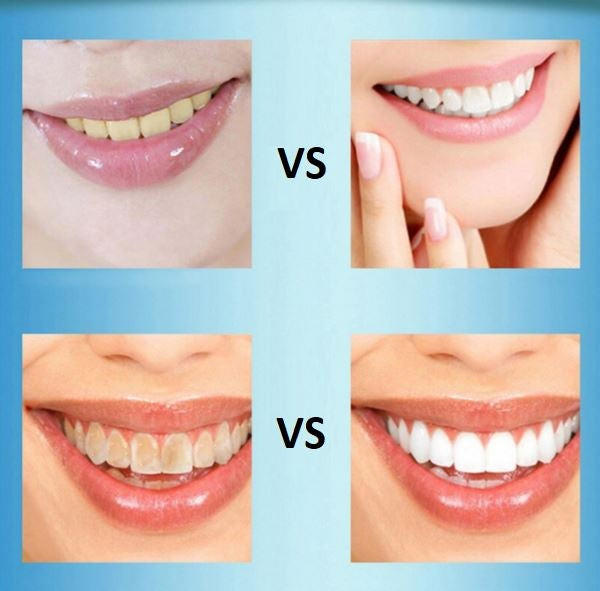Comment avoir des dents plus blanches grâce au charbon actif ?