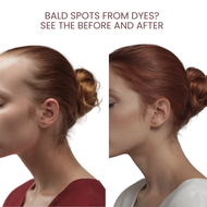 Bald Spots from Dyes?  See the before and after