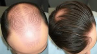 Why Is My Hair Falling Out? The Real Causes of Thinning & Balding Hair (And What You Can Do About It)