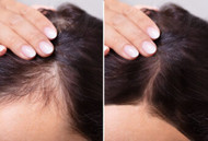 What Causes Hair Loss? 10 Common Reasons & What You Can Do