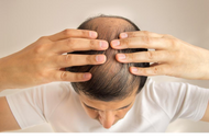 Top 5 Hair Loss Solutions: What Works and How to Choose