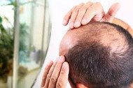 From Strands to Strength: Understanding & Tackling Hair Loss