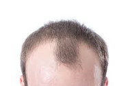 DHT Explained - The Hormone Behind Hair Loss & Thinning