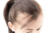 What Causes Excessive Hair Loss in Females AND What You Can Do