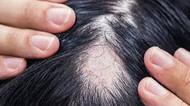 What Can Cause Hair Loss 