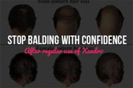 Stop Balding with Confidence