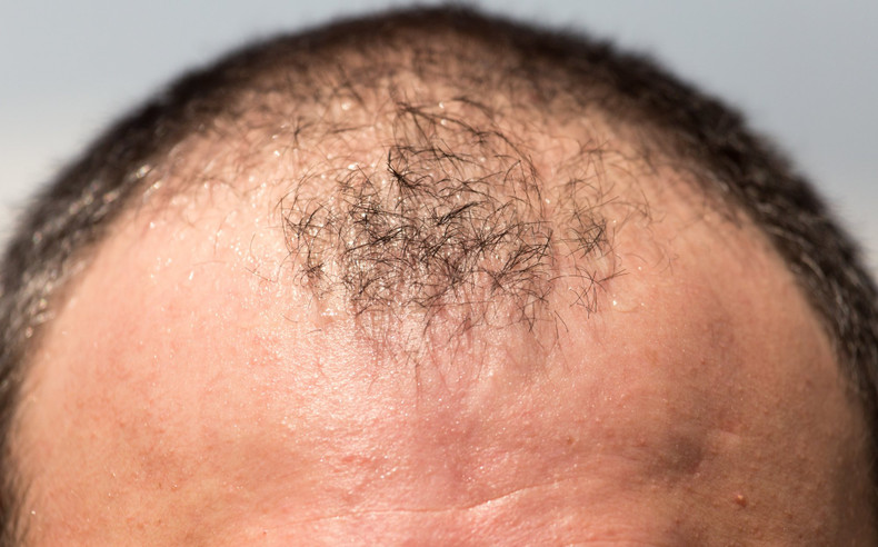 Effective Strategies to Regrow Hair on a Bald Spot