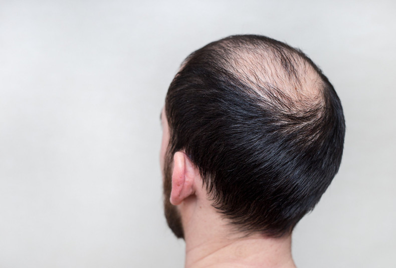 The Ultimate Guide: How to Regrow Hair Using Minoxidil Treatment