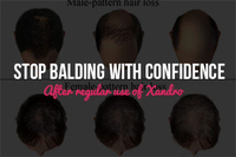 Stop Balding with Confidence