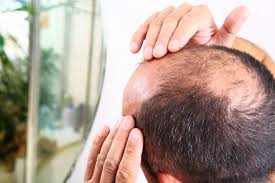 From Strands to Strength: Understanding & Tackling Hair Loss