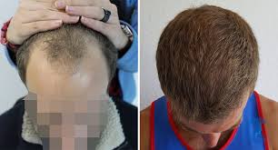 Hair Thinning? Here’s What Could Be Causing Your Hair Loss