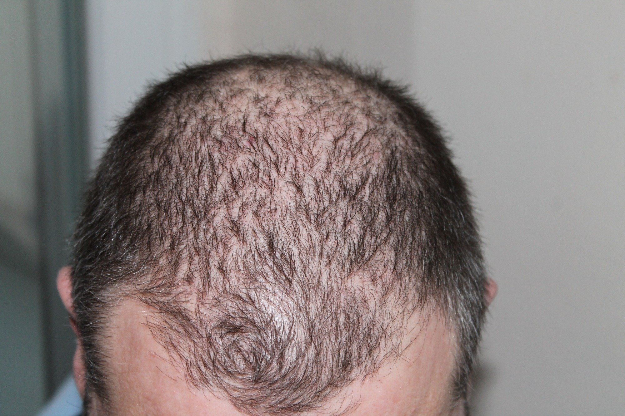 The Ultimate Guide to Hair Loss Treatment: Minoxidil 101