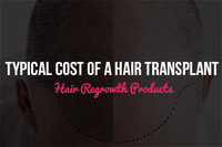 Typical Cost Of A Hair Transplant