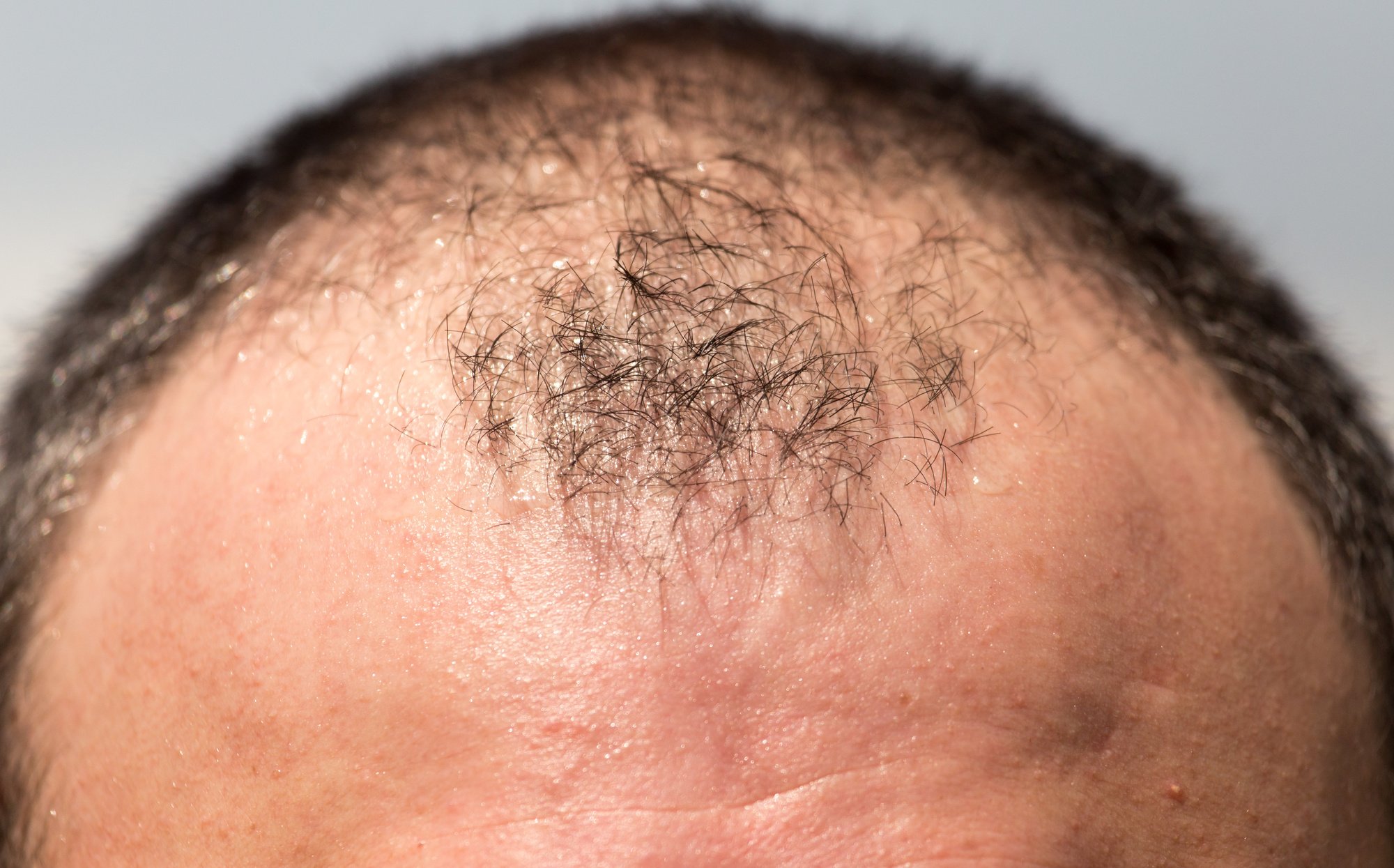 Xandrox Effective Strategies to Regrow Hair on a Bald Spot - Xandrox