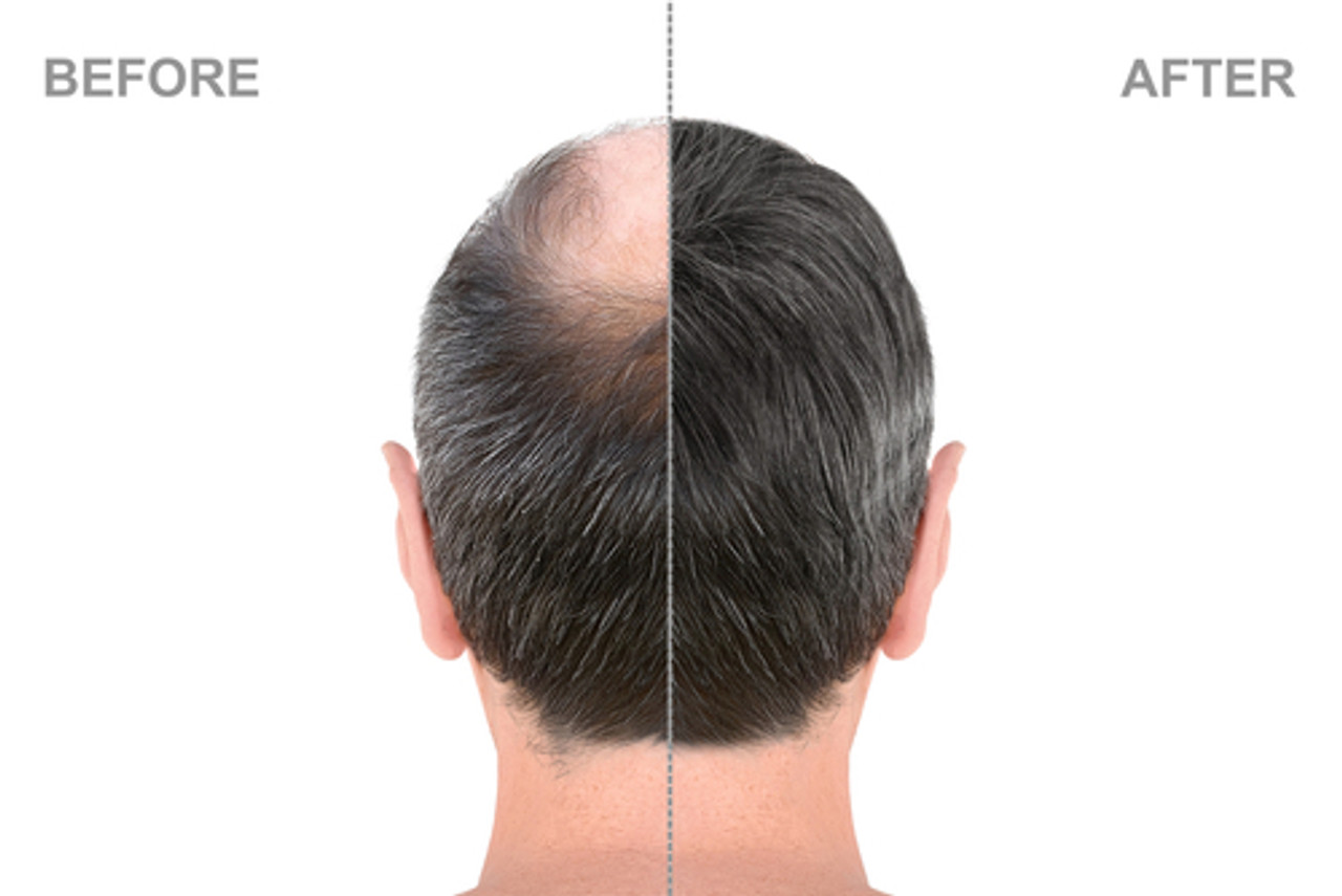 Xandrox Unlocking Hair Regrowth: Minoxidil, Azelaic Acid, and the Power of ...