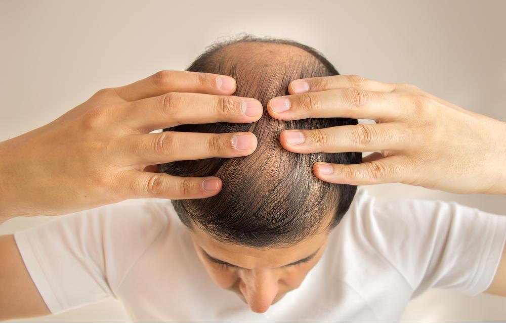 Xandrox Top 5 Hair Loss Solutions: What Works and How to Choose - Xandrox