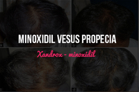 Xandrox Minoxidil Vesus Propecia - Xandrox