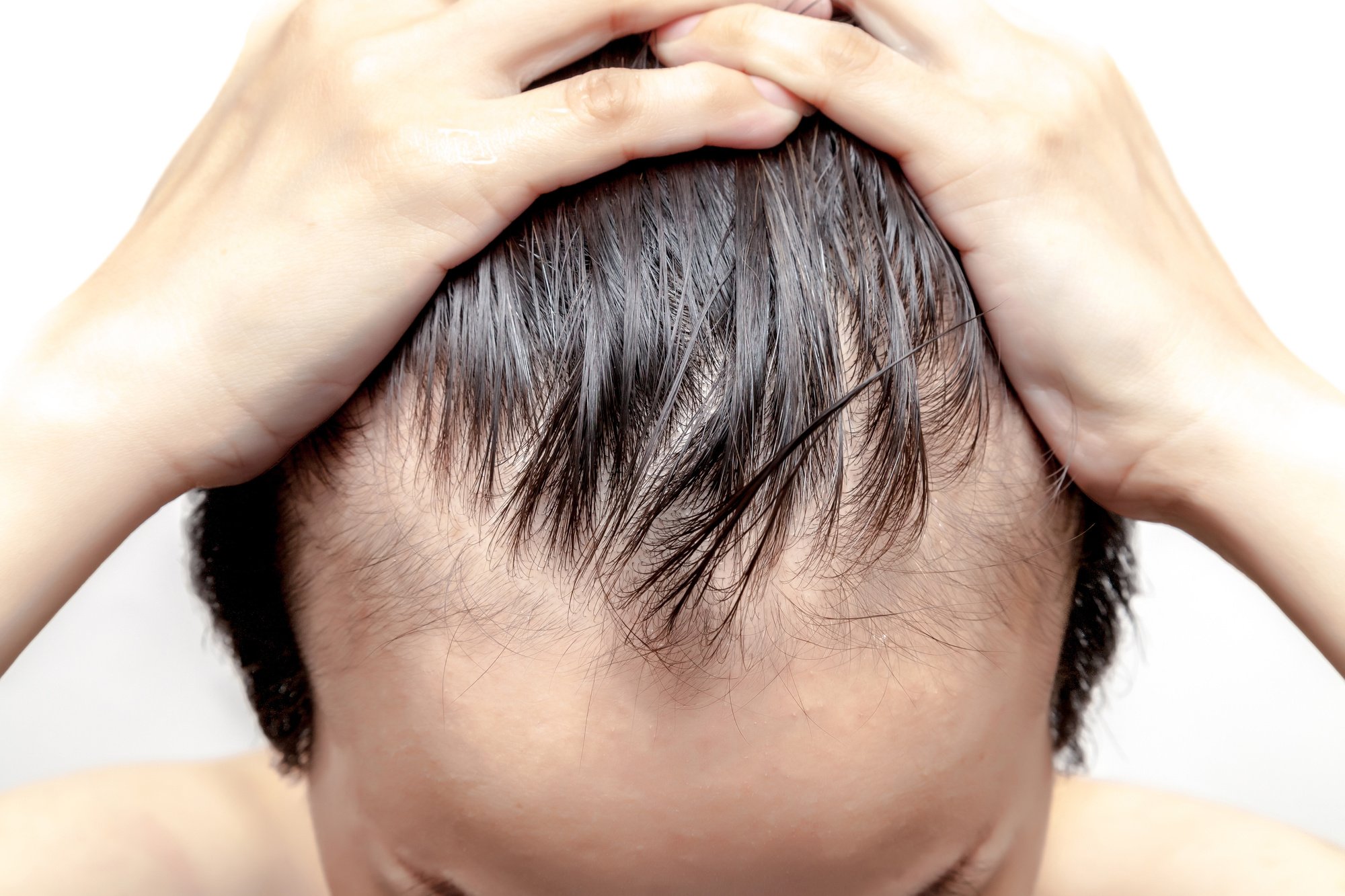 Xandrox The Ultimate Guide to Minoxidil: Stop Hair Loss and Regrow Thinning ...