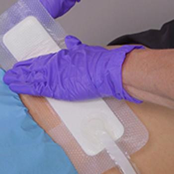 Smith & Nephew PICO PHMB Gauze Filler NPWT Antimicrobial – Single Configuration – Size 6"x 6¾"