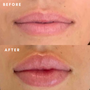 $75 off One Syringe of Lip and Fine Line Filler