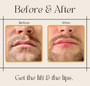 $75 off One Syringe of Lip and Fine Line Filler