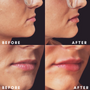 $400 off 2 Syringes of Cheek Chin and Jaw Line Filler