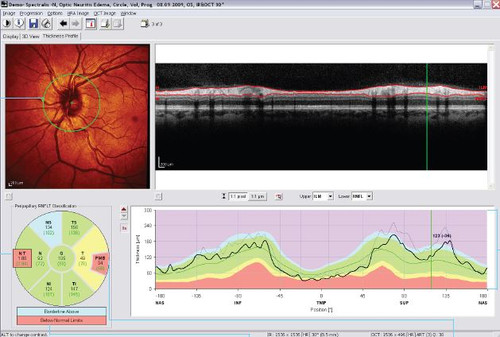 Heidelberg Spectralis N-Site Analysis Module