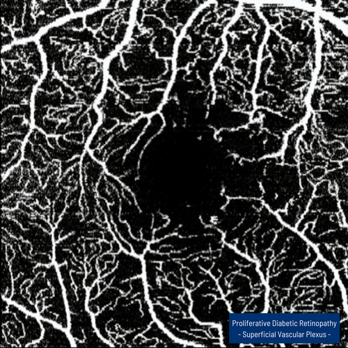 Heidelberg Spectralis OCT Angiography Module