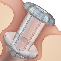 Oasis Flow Control Soft Plug