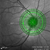 Heidelberg Spectralis Glaucoma Module Premium Edition