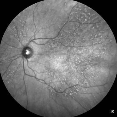 Heidelberg Spectralis - Widefield 55-degree Fundus & OCT Module