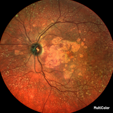 Heidelberg Spectralis - Widefield 55-degree Fundus & OCT Module