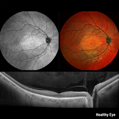 Heidelberg Spectralis - Widefield 55-degree Fundus & OCT Module