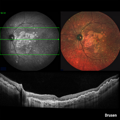 Heidelberg Spectralis - Widefield 55-degree Fundus & OCT Module