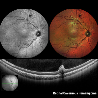 Heidelberg Spectralis - Widefield 55-degree Fundus & OCT Module