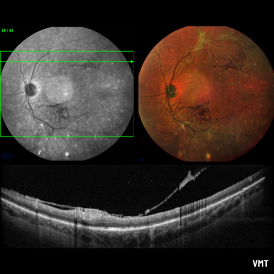 Module d’imagerie du fond d’œil et d’OCT à grand champ 55 degrés Spectralis Heidelberg