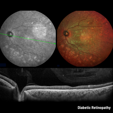 Heidelberg Spectralis - Widefield 55-degree Fundus & OCT Module